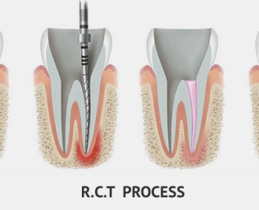 Save Your Tooth – Advanced Root Canal Treatment in Noida