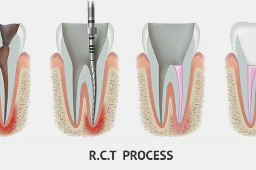 root canal treatment in sector 75 noida